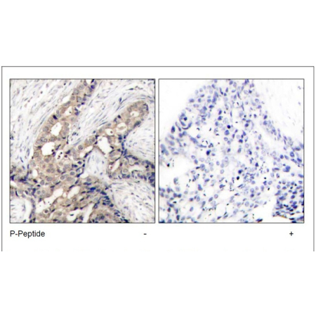 Human breast carcinoma