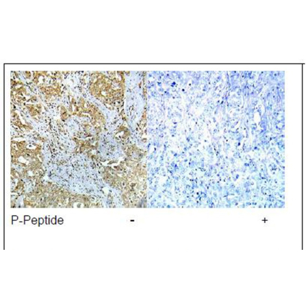 Human breast carcinoma