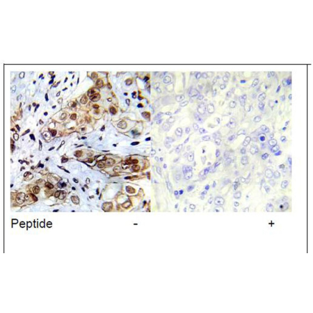 Human breast carcinoma