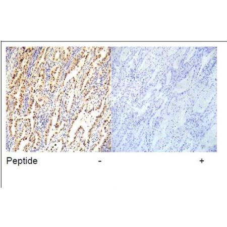 Human lung carcinoma