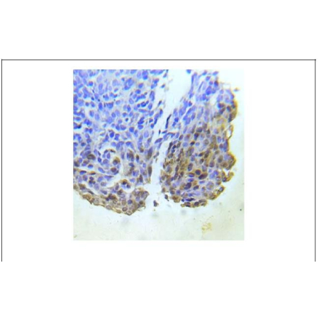 Human lung adenocarcinoma